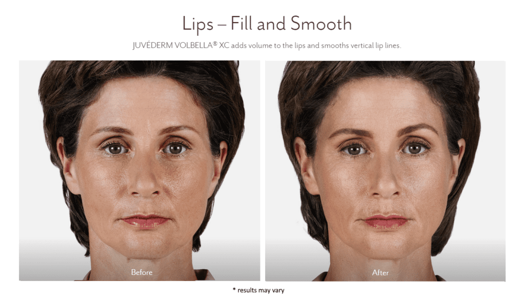 Woman's before and after dermal filler results.