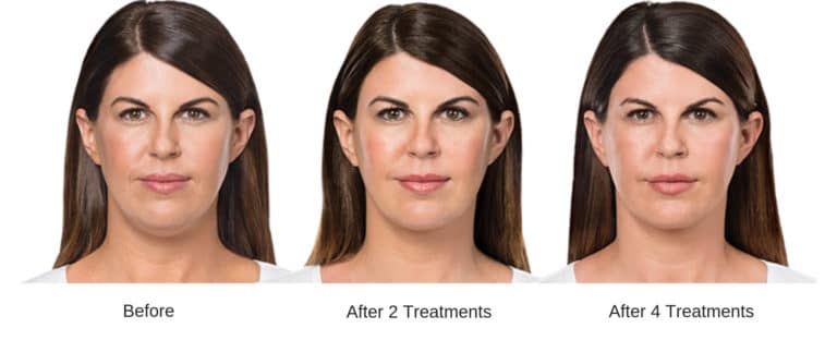 kybella chin early results