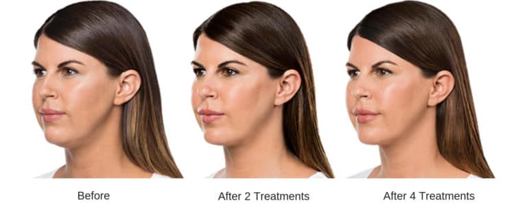 woman's profile after four kybella treatments