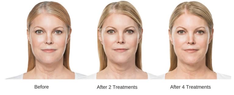 portrait image of a woman after two kybella double chin sessions