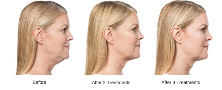 woman facing the side showing kybella results