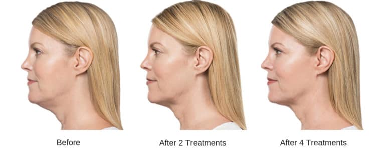 Woman's profile after 2 kybella treatments