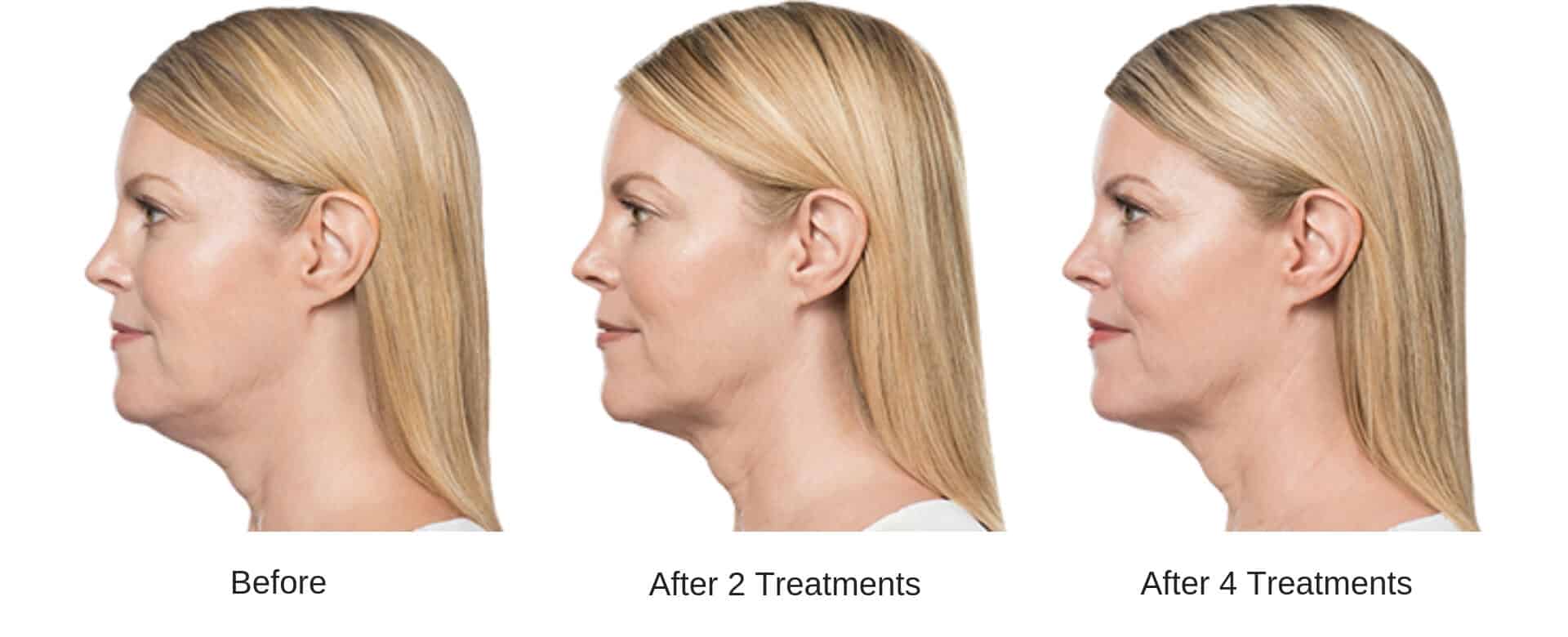 Woman's before and after kybella treatment results.