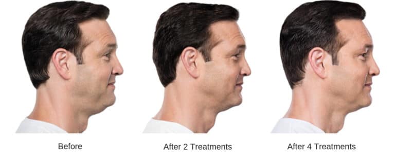 Man's kybella chin results.