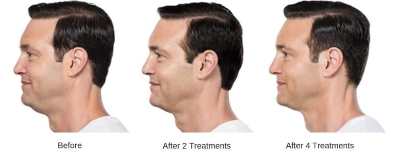 Man's before and after kybella treatment results.