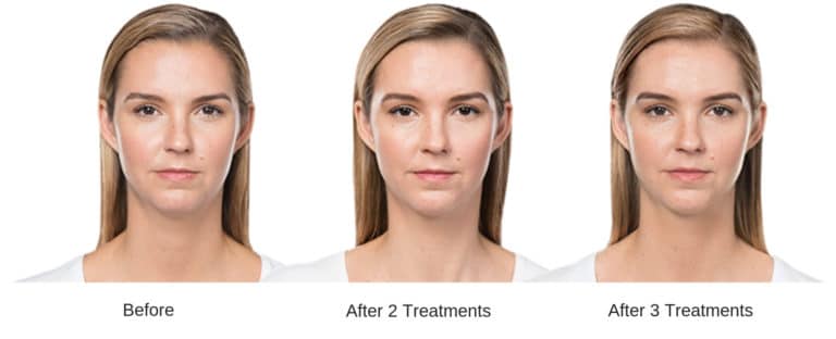 Woman's before and after kybella treatment results.