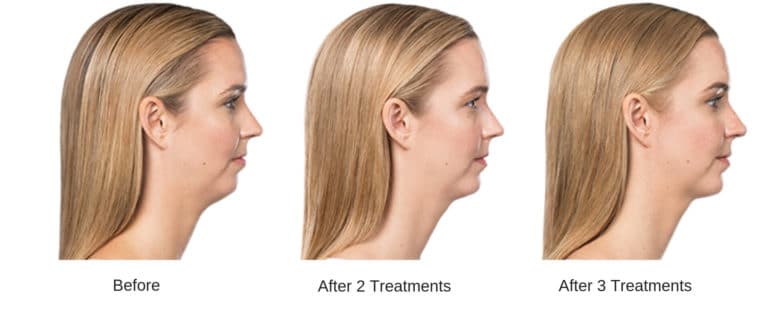 Side profile after woman receives 2 rounds of kybella for jowls