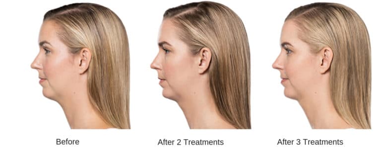 Woman's kybella injection results.