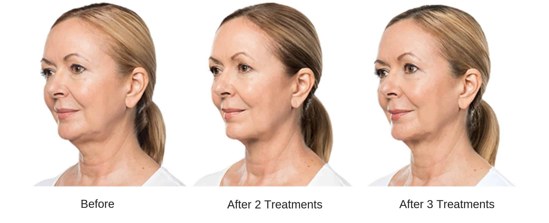 Woman's before and after kybella treatment results.