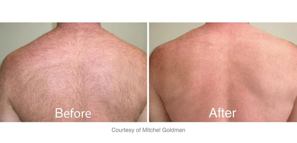 Mans back before and after laser hair removal.