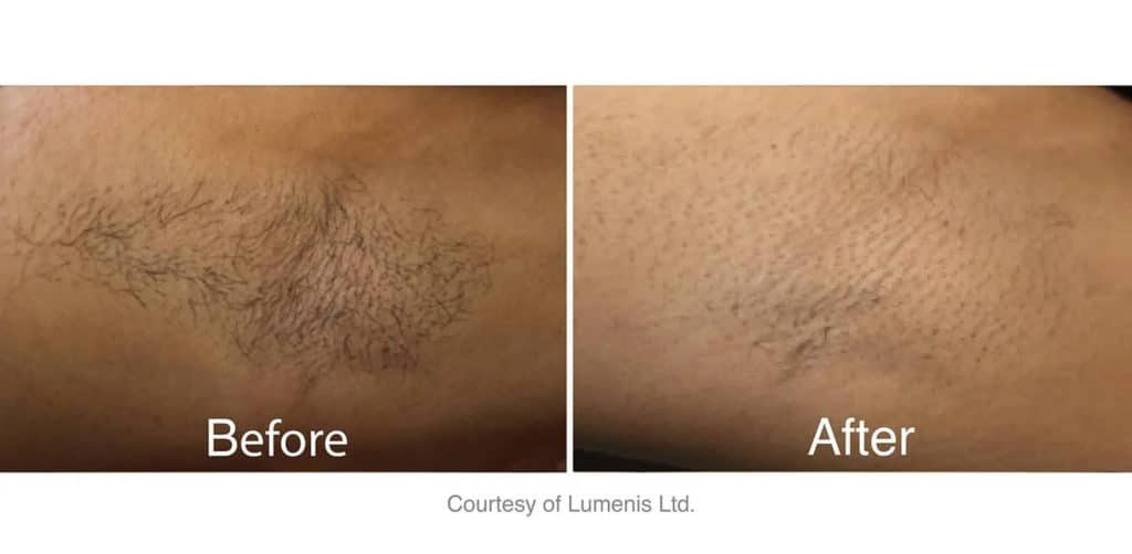 Armpit before and after laser treatment.