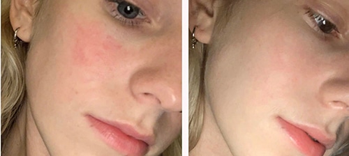 Womans before and after IPL to treat redness.