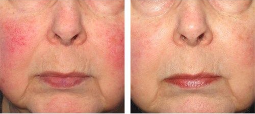 Womans before and after IPL treatment for rosacea.