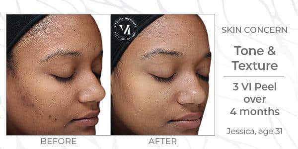 vi chemical peels treatment Newtown Square