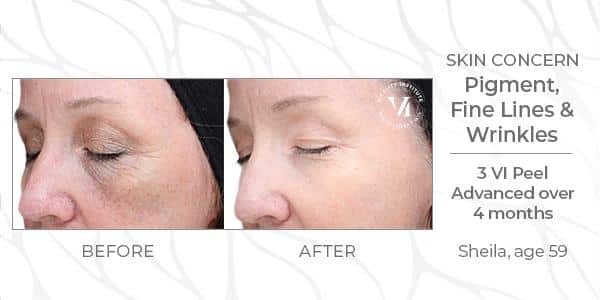 vi chemical peels Newtown Square, PA