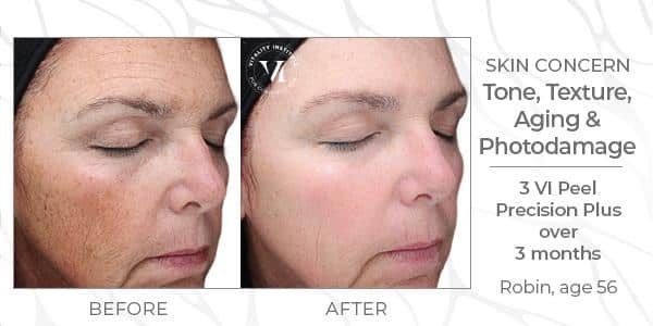 vi chemical peels in Newtown Square