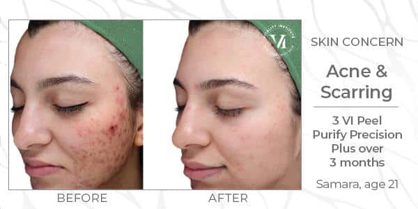 vi chemical peels KP Aesthetics