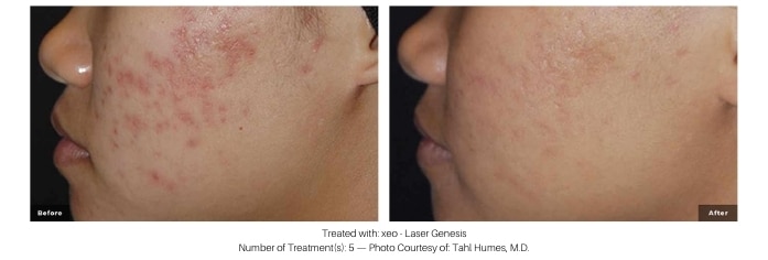 Woman's skin before and after laser facial at kp aesthetics.