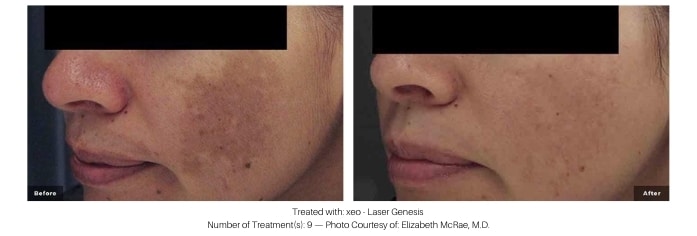 Woman's skin before and after laser facial at kp aesthetics.