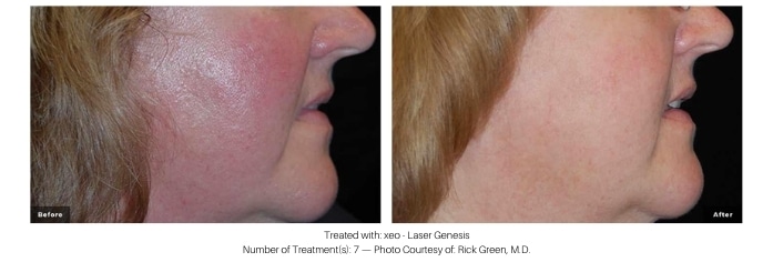 Woman's skin before and after laser facial at kp aesthetics.