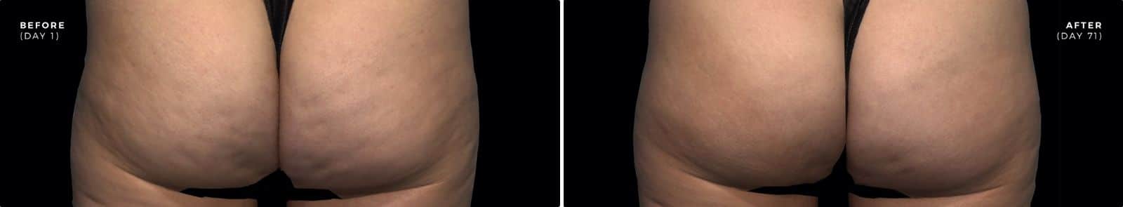 before and after pics of qwo cellulite treatment