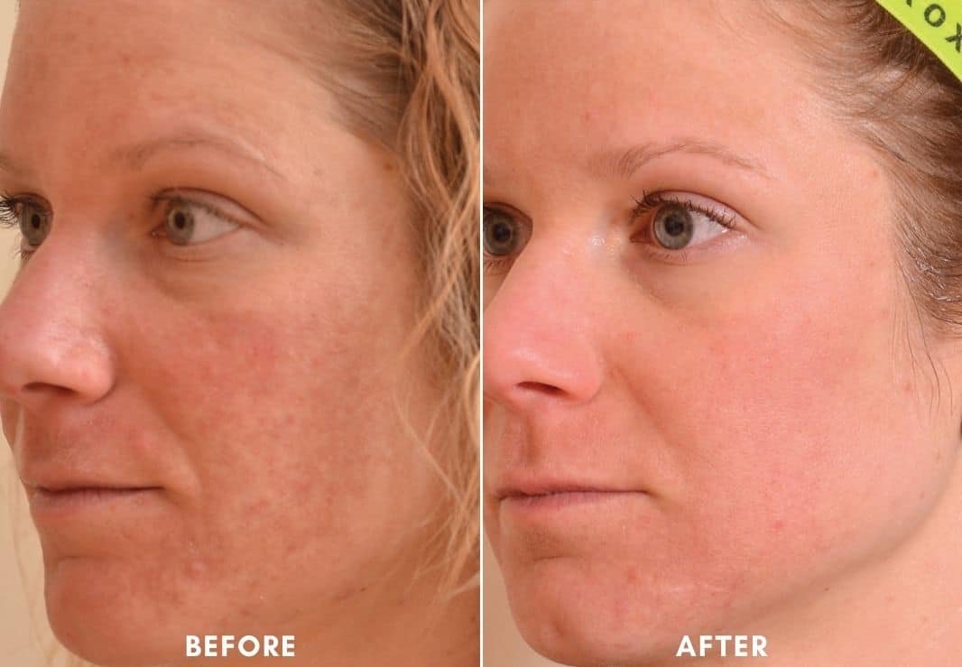 Womans face before and after Halo Laser Facial.