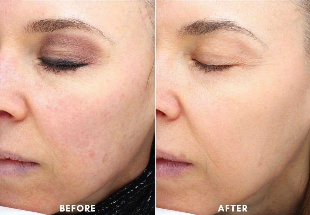 Womans face before and after Halo Laser Facial.