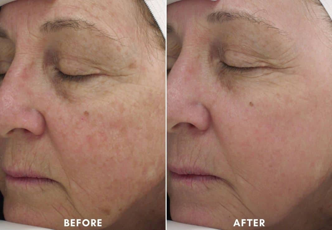 Womans face before and after Halo Laser Facial.