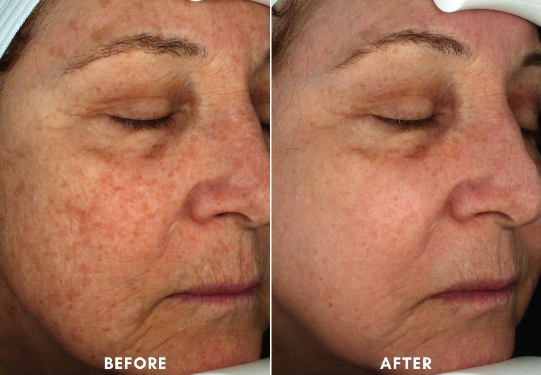 Womans face before and after Halo Laser Facial.