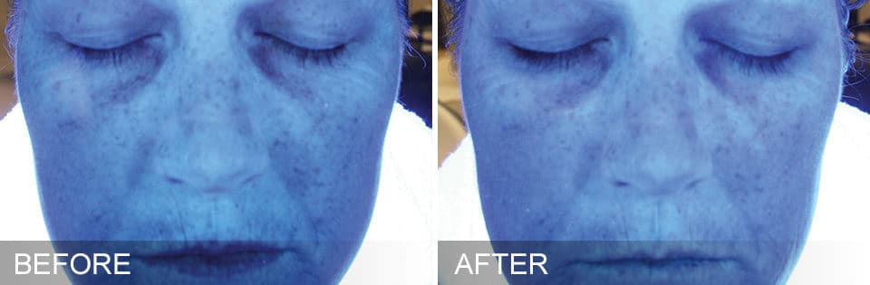 HydraFacial Before and After-1
