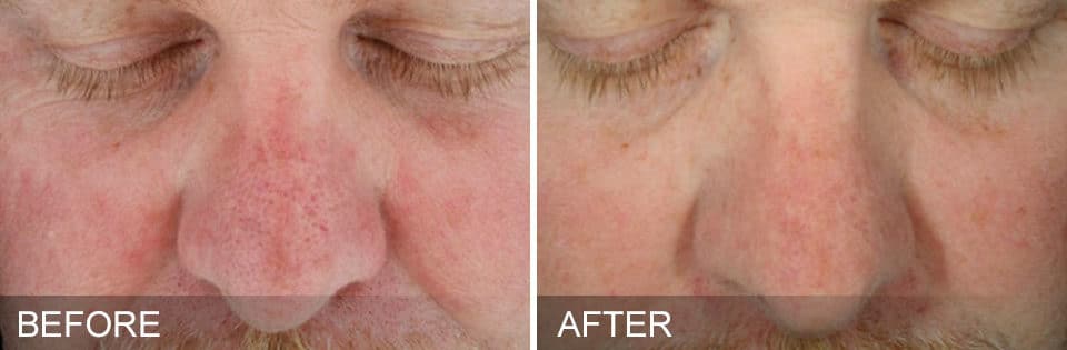 HydraFacial Before and After-2