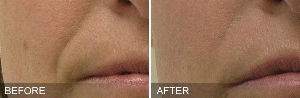HydraFacial Before and After-5