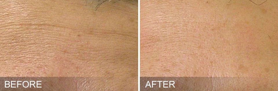 HydraFacial Before and After-6