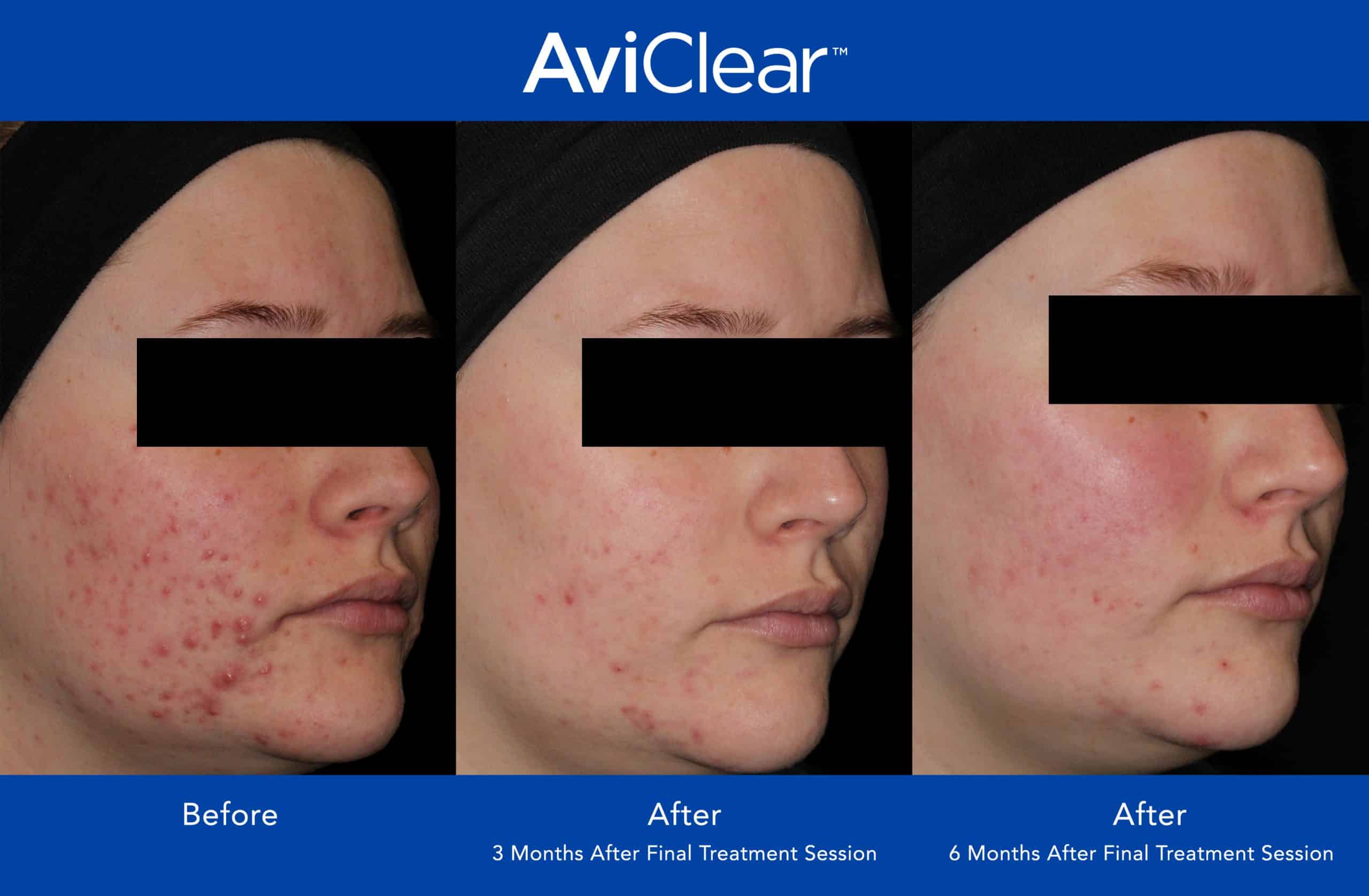 A before and after image of AviClear acne treatment in Newtown Square, PA