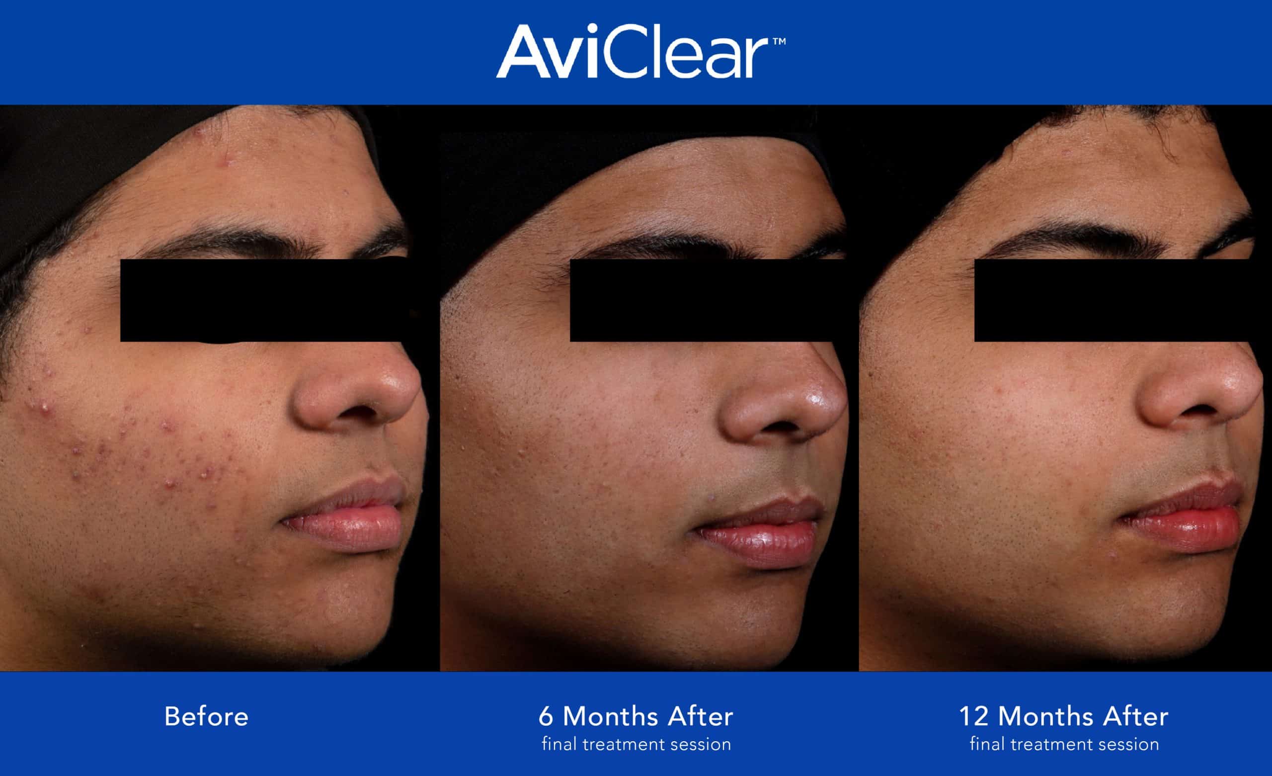An image showing a before and after the result of AviClear acne treatment in Newtown Square, PA