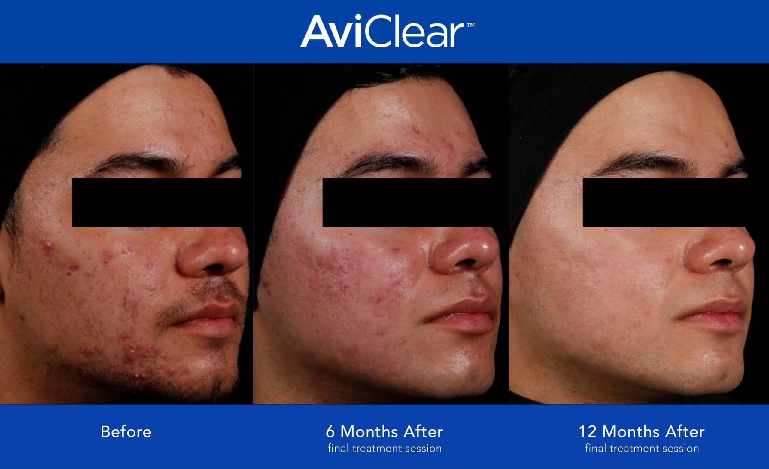 An image of the effects of the AviClear acne treatment before and after in Newtown Square, PA