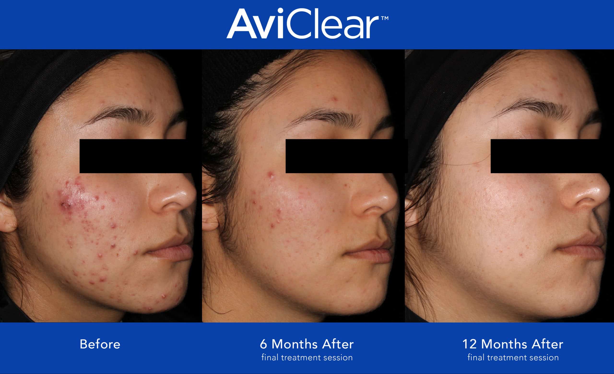 A picture displaying the results of the AviClear acne treatment before and after in Newtown Square, PA