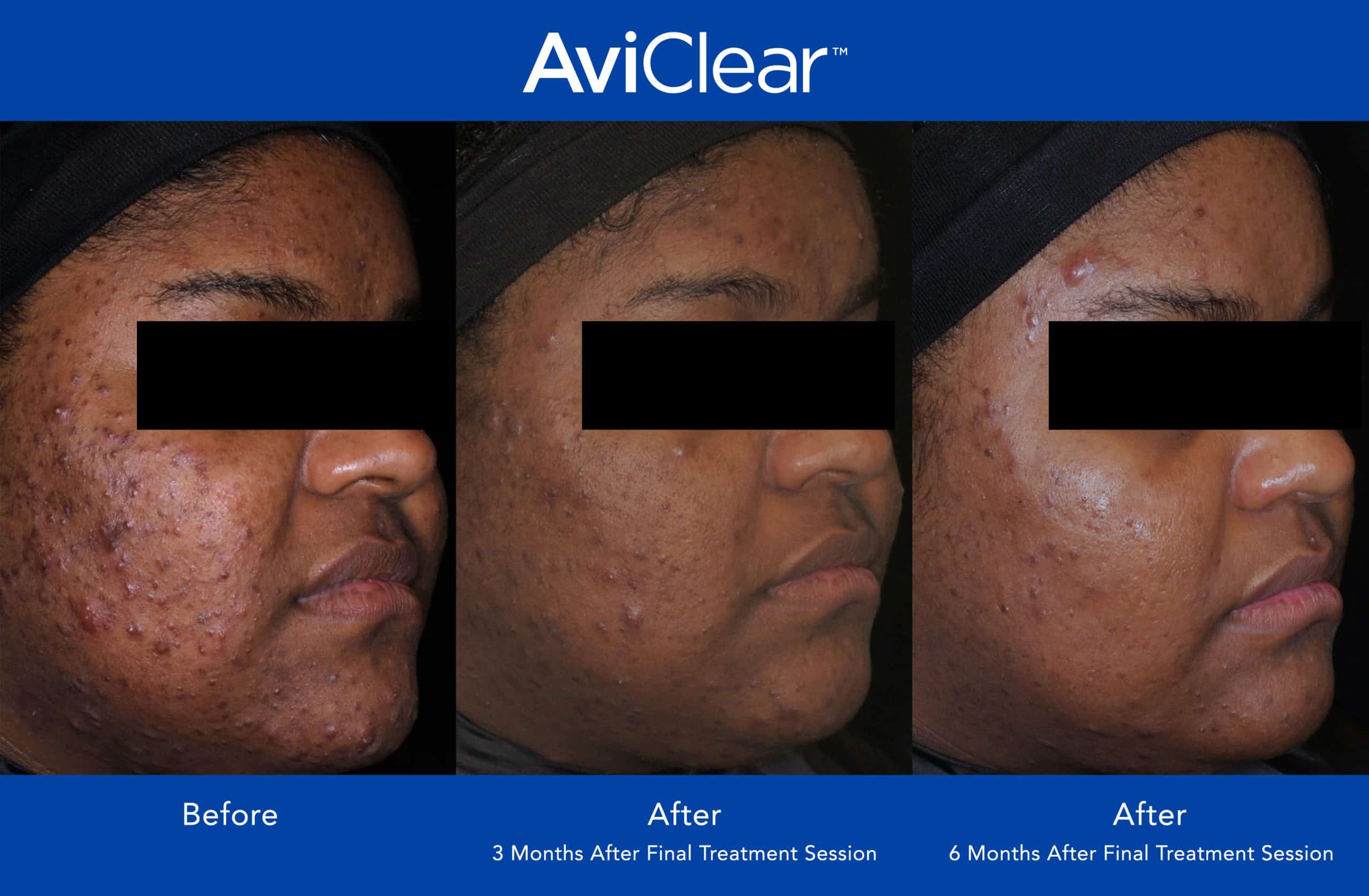 image of the results of the acne treatment AviClear in Newtown Square, PA