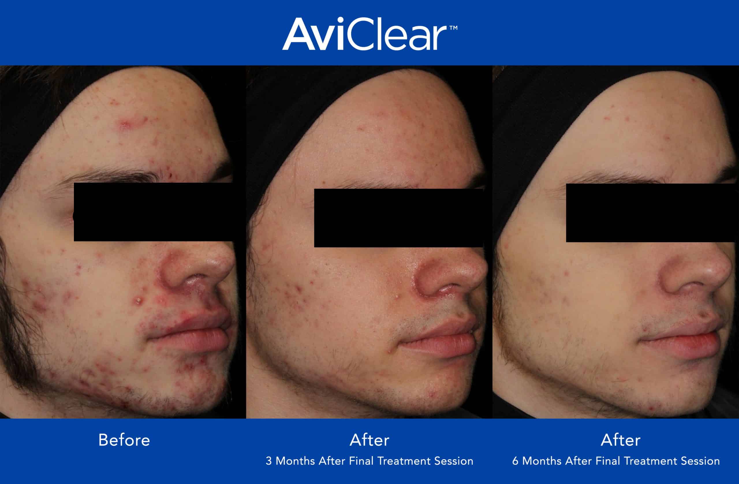 AviClear acne treatment before and after image in Newtown Square, PA