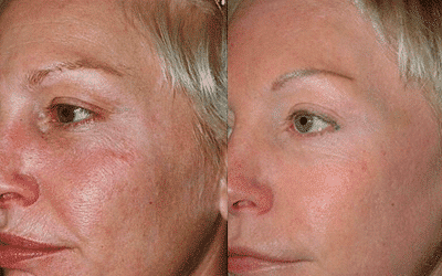 an image of a ClearLift before and after treatment in Philadelphia