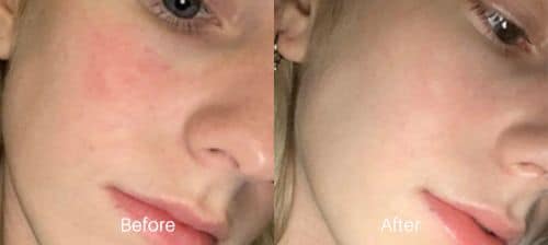 before and after treatment of IPL in Philadelphia