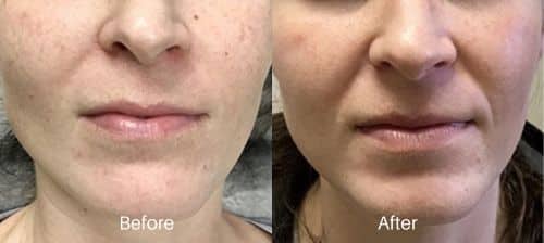 IPL before and after treatments in Newtown Square, PA