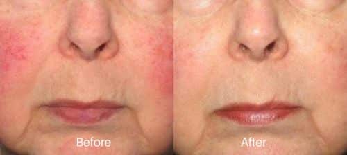 before and after treatment of IPL in Newtown Square, PA