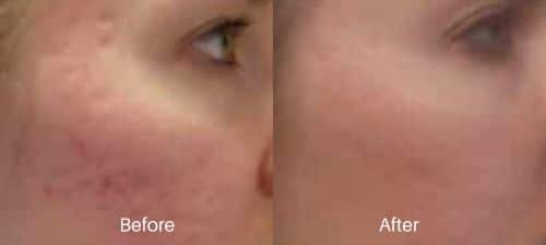 IPL before and after treatments in Philadelphia