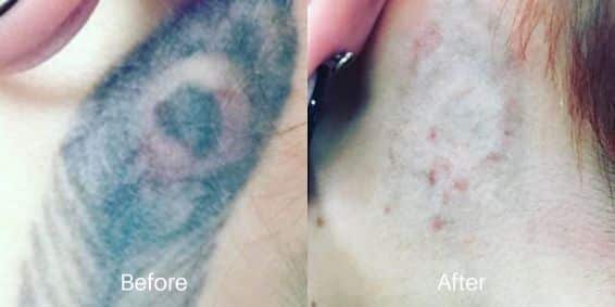 before and after treatment of Tattoo Removal in Newtown Square, PA