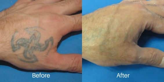 Tattoo Removal before and after treatment in Philadelphia