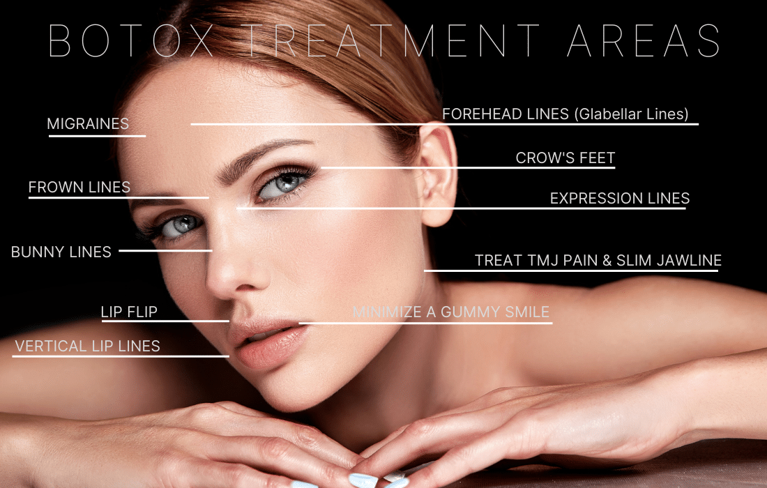 Botox treatment areas graphics.