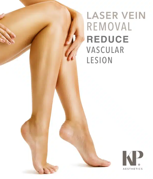 Laser Vein Reduction - Reduce Vascular Lesion - KP Aesthetics