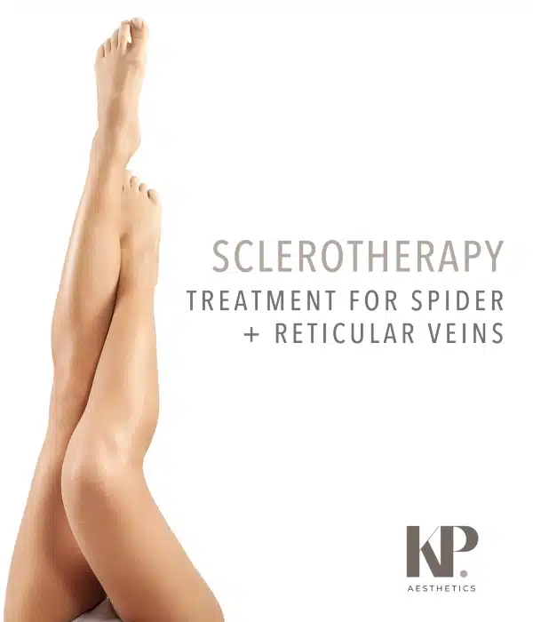 Sclerotherapy - Treatment for spider + reticular veins - KP Aesthetics